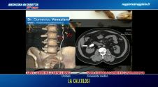 La calcolosi