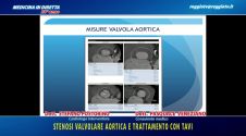 Stenosi valvolare aortica e trattamento con Tavi